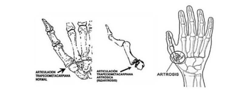 Rizartrosis: ¿Qué es y cómo combatirla?